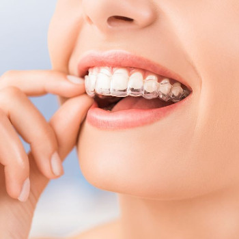 Aligner / Invisalign